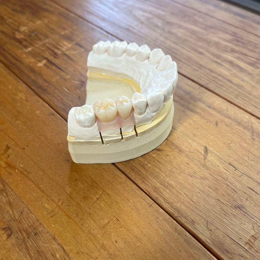 患者説明用模型 オールセラミック